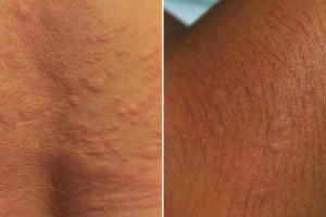 rash in skin