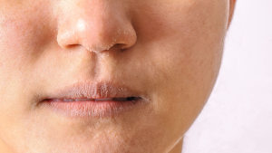 Dry or Dehydrated Skin